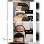 ترمیم مو مولیان