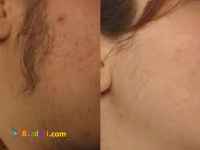 قیمت لیزر موهای زائد بدن در کلینیک کلاریون اسکین