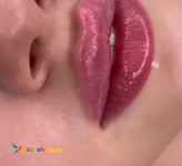 لاغری به روش اولترازد،فیلر،بوتاکس،لیفت نخ