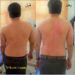 اصلاح انحرافات ستون فقرات بدون جراحی 